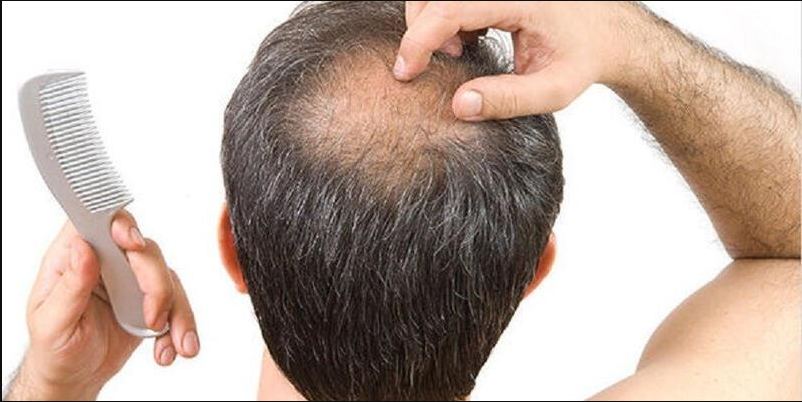 Sac Dokulmesi Neden Olur Ne Iyi Gelir